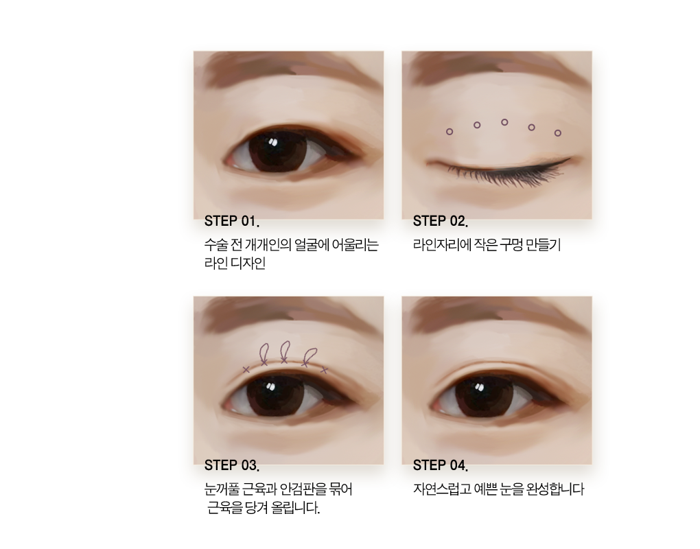 step 01 수술전 개개인의 얼굴에 어울리는 라인 디자인. step 02 라인 자리에 작은 구멍 만들기. step 03 눈을 정상적으로 뜰 수 있도록 근육의 장력을 조절하여 당김. step 04 자연스럽고 예쁜 눈을 완성합니다.