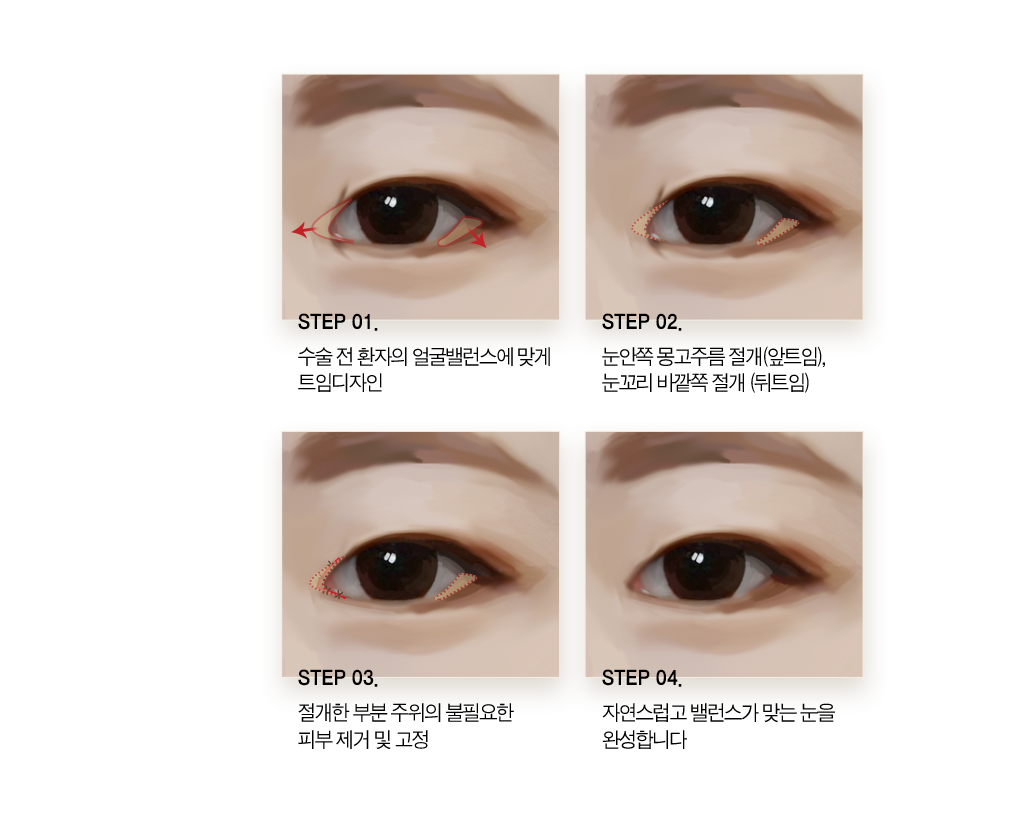 step 01 수술 전 환자의 얼굴 밸런스에 맞게 트임 디자인. step 02 눈안쪽 몽고주름 절개(앞트임) 눈고리 바깥쪽 절개 (뒤트임). step 03 절개한 부분 주위의 불필요한 피부 제거 및 고정 step 04 자연스럽고 밸런스가 맞는 눈을 완성합니다.