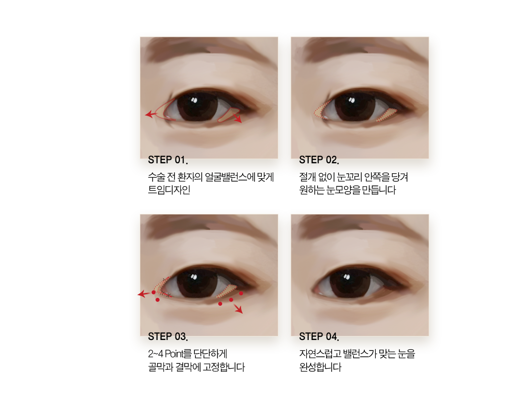 step 01 수술 전 환자의 얼굴 밸런스에 맞게 트임 디자인. step 02 절개 없이 눈고리 안쪽을 당겨 원하는 눈모양을 만듭니다. step 03 2~4 point를 단단하게 골막과 결막에 고정합니다. step 04 자연스럽고 밸런스가 맞는 눈을 완성합니다.