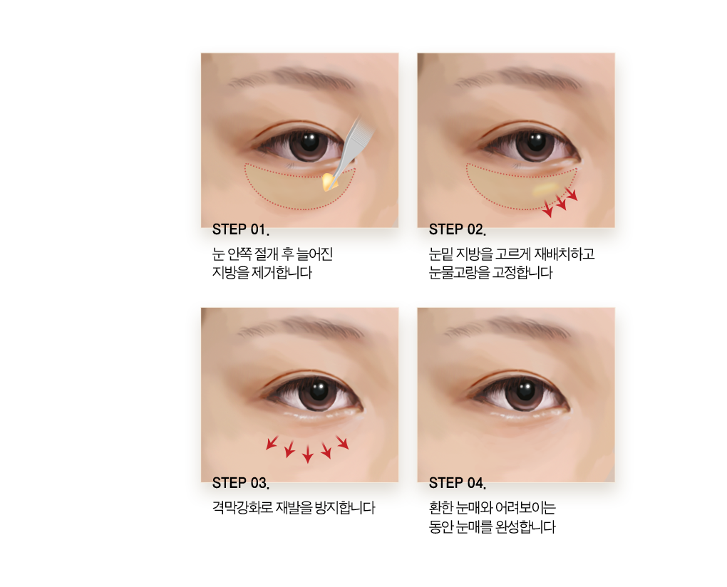 step 01 눈 안쪽 절개 후 늘어진 지방을 제거합니다. step02 눈밑 지방을 고르게 재배치하고 눈물 고랑을 고정합니다. step03 격막 강화로 재발을 방지합니다. step04 환한 눈매와 어려보이는 동안 눈매를 완성합니다.