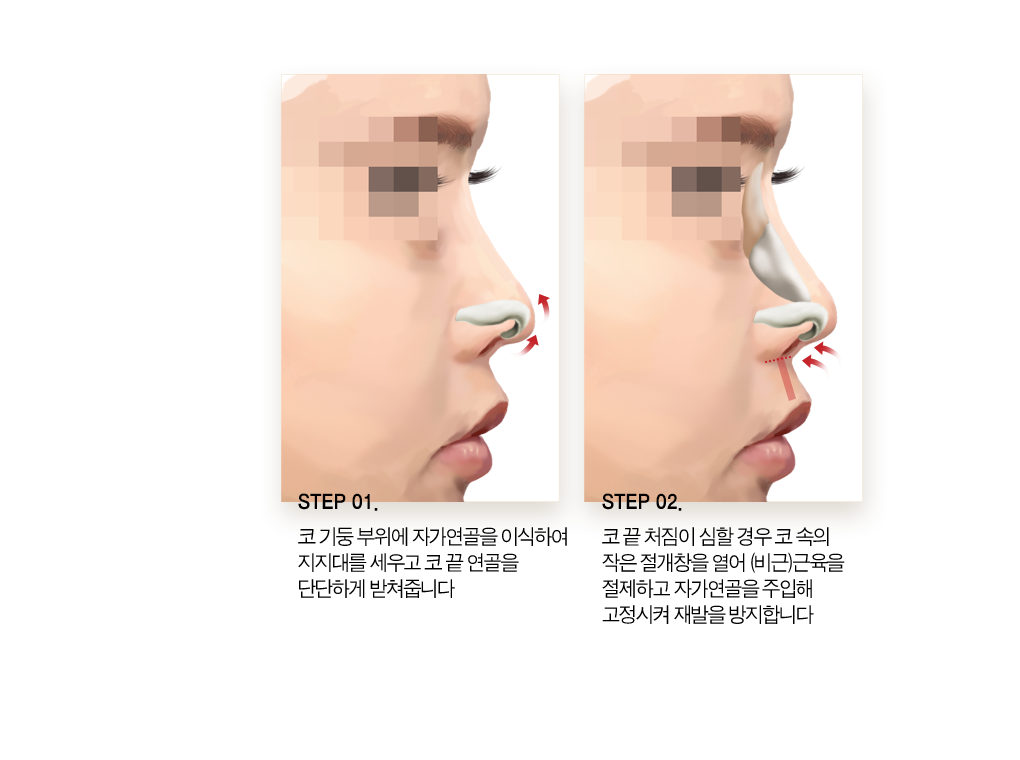 step01 코 기둥 부위에 자가연골을 이식하여 지지대를 세우고 코 끝 연골을 단단하게 받쳐줍니다. step02 코 끝 처짐이 심할 경우 코 속의 작은 절개창을 열어 (비근) 근육을 절제하고 자가 연골을 주입해 고정시켜 재발을 방지합니다.