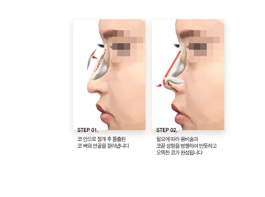 step01. 코 안으로 절개 후 돌출된 코 뼈와 연골을 잘라냅니다. step02. 필요에따라 융비술과 코 끝 성형을 병행하여 반듯하고 오똑한 코가 완성됩니다.