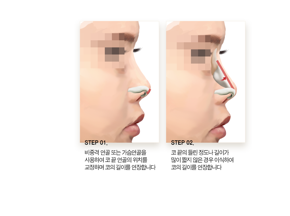 step01 비중격 연골 또는 가슴연골을 사용하여 코 끝 연골의 위치를 교정하여 코의 길이를 연장합니다. step02 코끝의 틀린 정도나 길이가 많이 짧지 않은 경우 이식하여 코의 길이를 연장합니다.