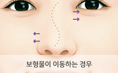보형물이 이동하는 경우
