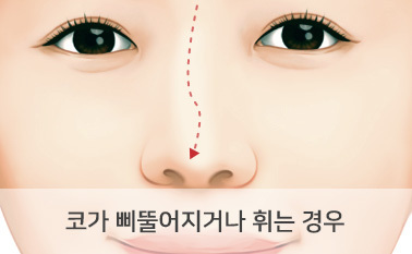 코가 비뚤어지거나 휘는 경우
