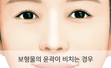 보형물의 윤곽이 비치는 경우