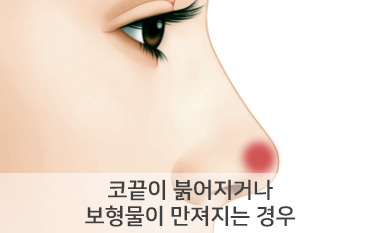 코끝이 붉어지거나 보형물이 만져지는 경우