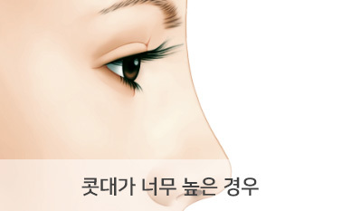 콧대가 너무 높은 경우