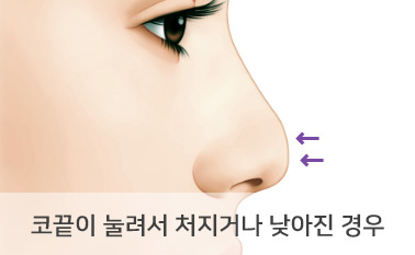 코끝이 눌려서 처지거나 낮아진 경우