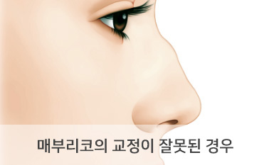매부리코의 교정이 잘못된 경우