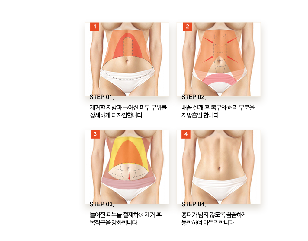 step01 제거할 지방과 늘어진 피부 부위를 상세하게 디자인 합니다. step02 배꼽 절개 후 복부와 허리 부분을 지방흡입 합니다. step03 늘어진 피부를 절제하여 제거 후 복직근을 강화합니다. step04 흉터가 남지 않도록 꼼꼼하게 봉합하여 마무리 합니다.