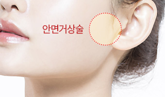 안면거상술