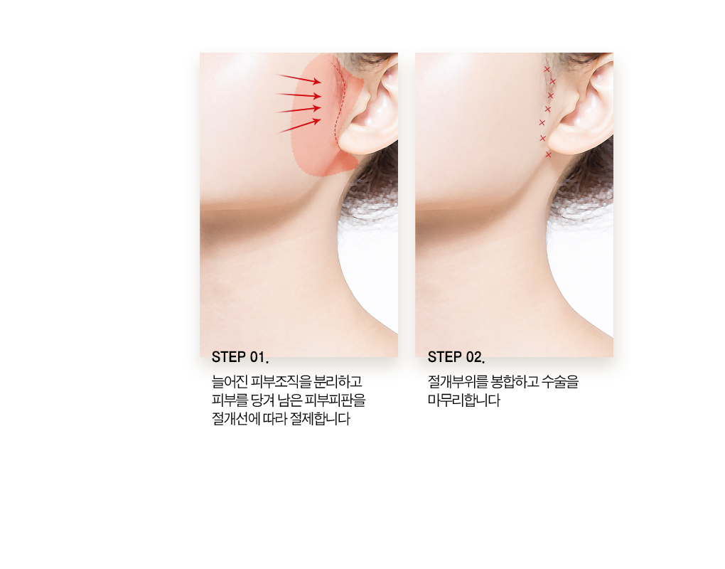 step01 늘어진 피부조직을 분리하고 피부를 당겨 남은 피부피판을 절개선에 따라 절제합니다. step02 절개부위를 봉합하고 수술을 마무리 합니다.