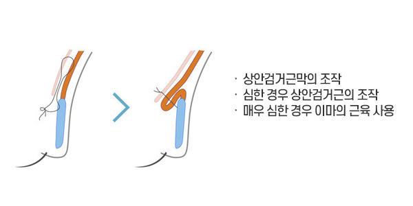 상안검거근 조작, 뮬러근 길이를 줄여줍니다. 증상이 심한 경우 이마의 전두근을 사용하여 교정합니다