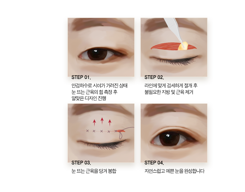 step 01 눈뜨는 근육에 매듭을 만들어 줍니다. step 02 매듭을 이어줌으로써 눈꺼풀 안쪽에서 자연스럽게 쌍커풀 라인을 고정합니다. step 03 눈뜨는 근육의 길이가 짧아져 근육힘이 조절되고 또렷한 눈이 됩니다.